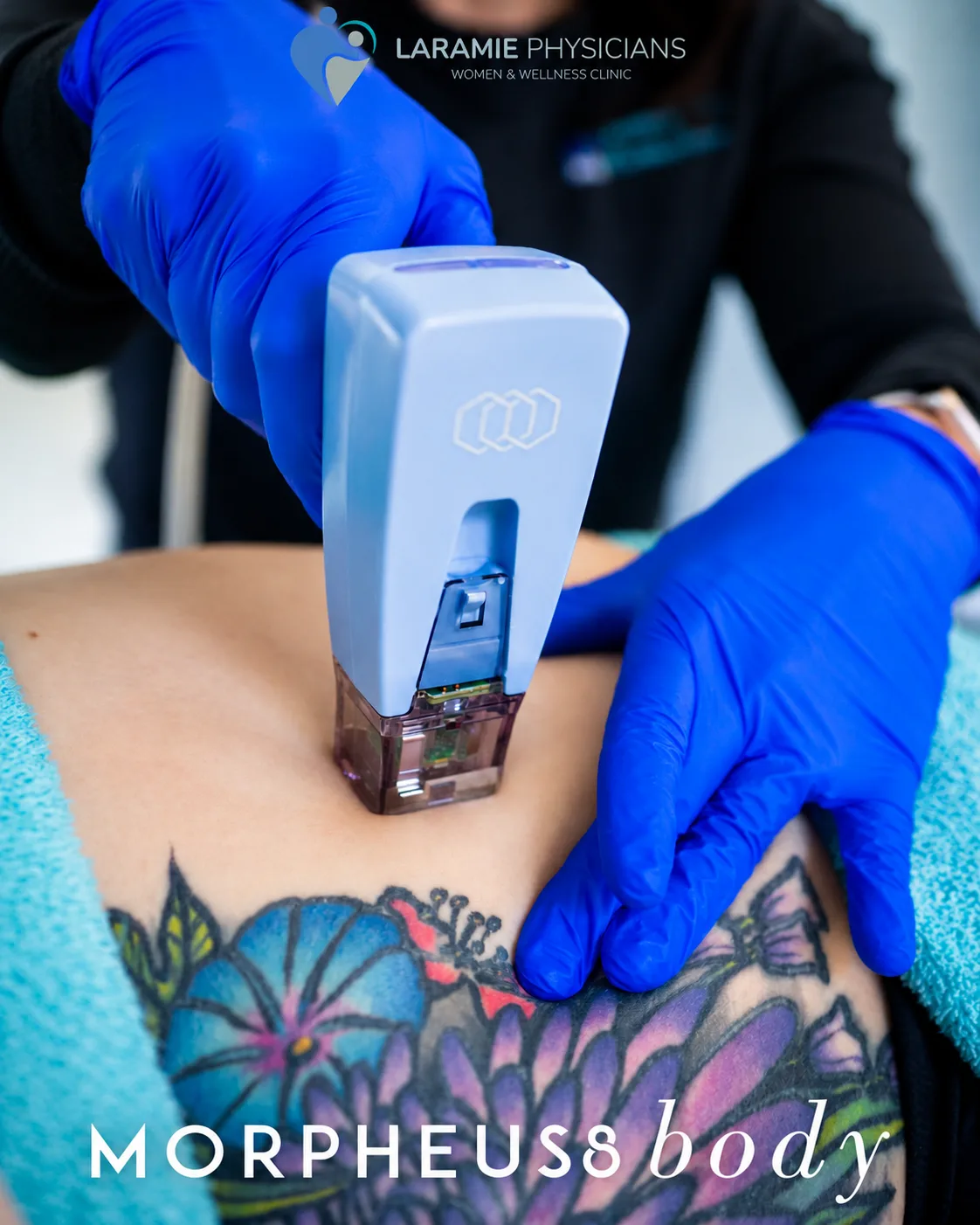 Clinician performing a Morpheus8 Body treatment on a patient's abdomen